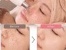 【夏の紫外線ブロック】シミ改善&IPL光フォト×韓国式美白ケア付き¥16990→