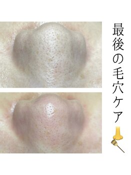 ジョアン(Johan)/究極毛穴掃除エクストラクション