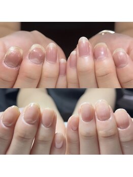 セラキュアネイル(Theracure nail)/爪の悩みは人それぞれ