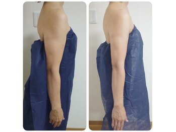 アンティクイーン(Antiqueen)/二の腕ほっそり