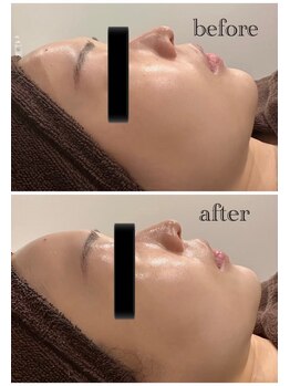 ツール(TOOL)/ハーブピーリング