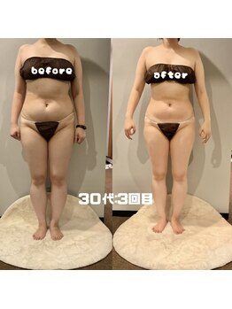 ソウソウビューティー 五反田(Shou Shou Beauty)/ビフォー☆アフター　3回目