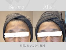 アイシス(AIsis)/【たるみ】LDMハイプレミアム