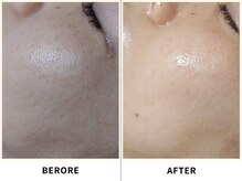 リノア(Linoa)/before/after