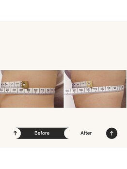 プラチナアース つくば店(Platinum earth)/【1回で-1.5cm】二の腕スッキリ