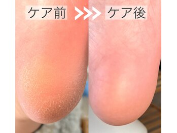 ケアリ(CAREri)/【大好評】1回でこの変化