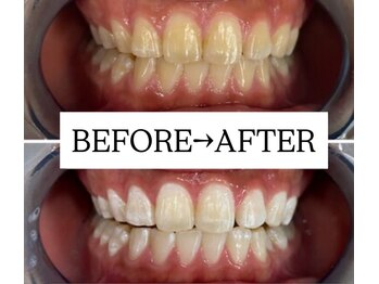 ホワイトニングサロン 宝塚/Before&After美白ホワイトニング