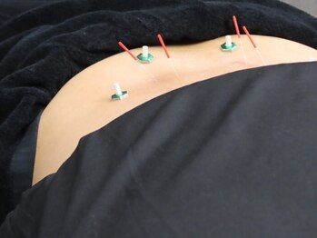 ケアフォー 西小山(Carefor)の写真/デスクワークや家事・育児でお疲れの方にオススメ♪当店の鍼灸で首や肩の痛みを根本から解消しています！