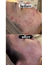 ミエル(miel)/ニキビケア