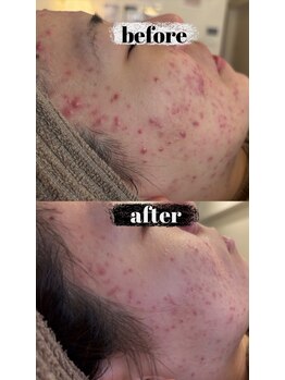 ミエル(miel)/ニキビケア