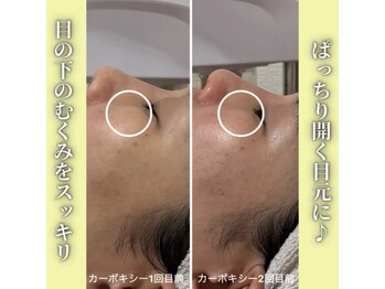 ハニエル(Haniel)/カーボキシー症例