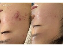 サロンムーン 赤坂(salon moon)/皮膚科に行っても困っていた
