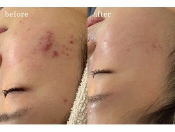 サロンムーン 赤坂(salon moon)/皮膚科に行っても困っていた