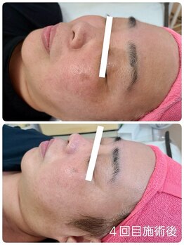 キレイ(KIREI)/シミケアにも実績あり！