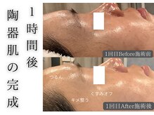 チッチ アフロディーテ(Chicchi Aphrodit)/毛穴洗浄×ハーブピーリング