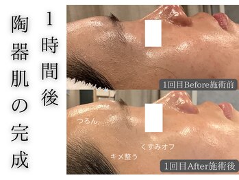 チッチ アフロディーテ(Chicchi Aphrodit)/毛穴洗浄×ハーブピーリング