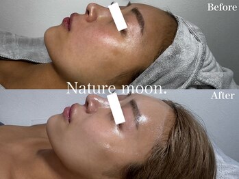 ナチュールムーン(Nature moon.)/ハーブピーリング