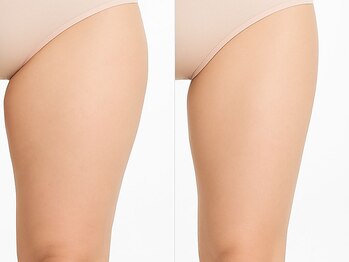 オリエンタルローザ 表参道(Oriental Rosa)の写真/【日本初】冷却×EMSを同時出力する革新痩身で最速効果!パッド型で吸引跡ゼロ☆広範囲を均一に冷却引き締め