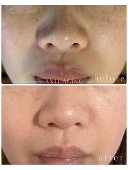 ミエル(miel)/シミケア