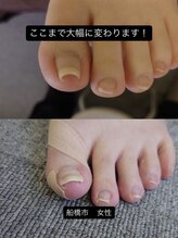 巻き爪じゅん　津田沼駅前店　【副爪/肥厚爪/深爪/フットケア】/布団が当たるだけでも痛い巻爪！