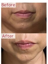 リュクスルーム(Luxe room)/プラズマ＋レッドショット　１回