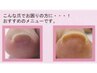 【巻爪ケア】フット☆巻爪でお悩みの方¥4500→¥4000
