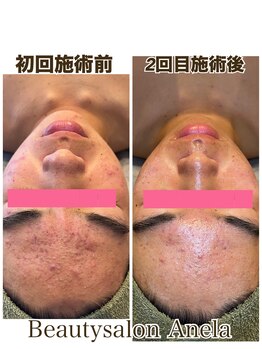 アネラ(Anela)/ホームケアも併せてご使用です♪