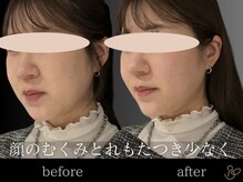 チョコバリ 新宿店(chocobari)/小顔×リフトアップ(美容鍼)20代