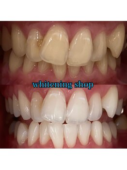 ホワイトニングショップ 大阪玉造店/Before&After美白ホワイトニング