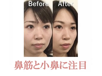 ラプリシュシュ 岡山店(Raplit)/隆鼻+輪郭矯正40分10回