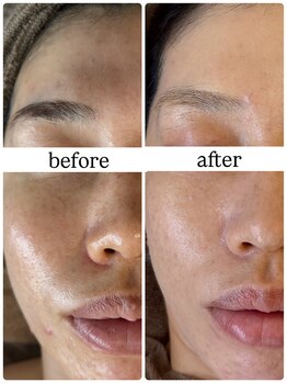 ミエル(miel)/弱った肌にもハーブピーリング