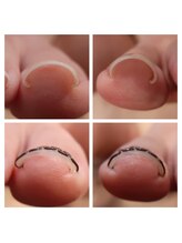 フットサロンアーチ 新小岩/爪でお悩みの方はご相談ください