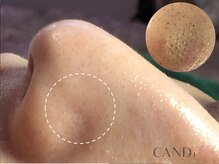 キャンディ 難波心斎橋店(CANDi)/ハイドラピーリング/黒ずみ毛穴