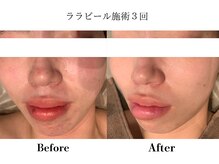 フレイヤ(FREYA)/ララピールBefore→After