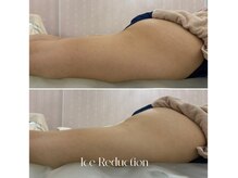 エステティックサロン フェアリー(ESTHETIC SALON FAIRLY)/痩身＊脂肪冷却ビフォーアフター