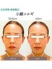 【左右対称小顔コルギ】矯正×LDMでエラほぐし/モニター価格70分9,800円