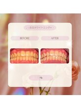 プラスビー 2号店(+b)/ホワイトニングビフォーアフター