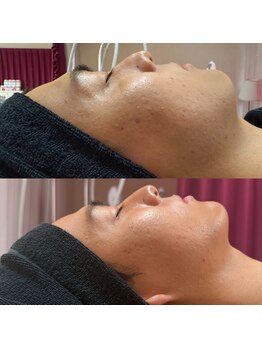 マヤヒメ(mayahime)/オンダリフト１度の施術