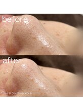 ルルラ リコ(lulula rico)/症例写真/ハイドラ毛穴洗浄