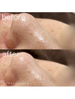 ルルラ リコ(lulula rico)/症例写真/ハイドラ毛穴洗浄
