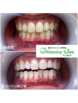ホワイトニングサロン 名古屋駅店/【ホワイトニング施術例】