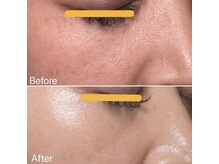 ファンデいらずの透明素肌へ。毛穴/しわ/たるみ/シミ/表参道