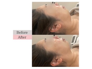 フロリール アザブジュウバン(FlorirAzabujuban)/3D小顔/造顔フェイシャル