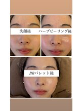 ミエル(miel)/ハーブピーリング直後のお肌