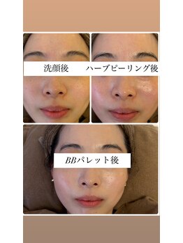 ミエル(miel)/ハーブピーリング直後のお肌