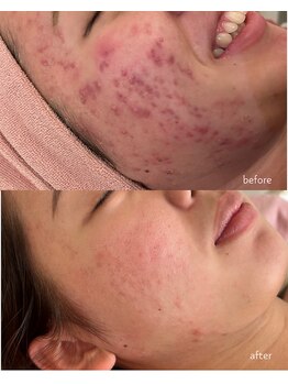 ナンバーナイン(No.9)/ニキビ改善