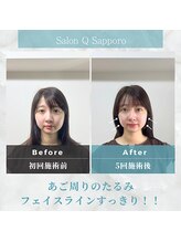 キューサッポロ(SalonQSapporo)/フェイスラインビフォーアフター