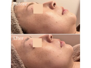 エービューティーサロン 松山店(A BEAUTY SALON.)/40代女性　二重アゴ改善