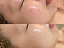 ビジュープラス 広島店(Bijou+)/【20代/ニキビケア】