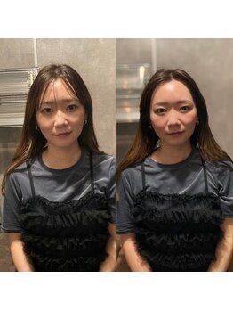ルディア 堂島店(ledia)/大阪美容鍼 ビフォーアフター